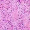 6B3 Ependymoma, mixed (clear cell) (Case 6) H&E 3