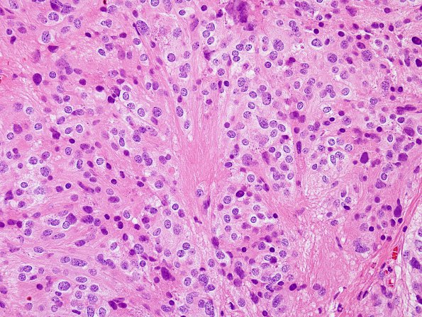 6B3 Ependymoma, mixed (clear cell) (Case 6) H&E 3