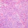 6B4 Ependymoma, mixed (clear cell) (Case 6) H&E 1