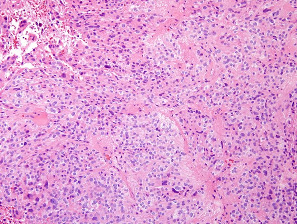 6B4 Ependymoma, mixed (clear cell) (Case 6) H&E 1