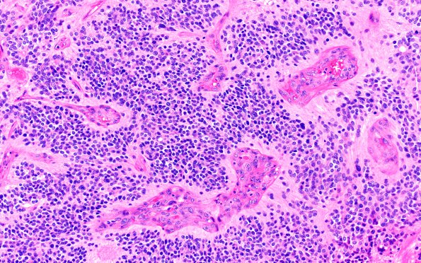 7A1 Ependymoma, anaplastic, clear cell (Case 7) H&E 20X