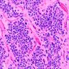 7A2 Ependymoma, anaplastic, clear cell (Case 7) H&E 40X