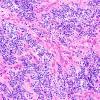 7A3 Ependymoma, anaplastic, clear cell (Case 7) H&E 20X 3