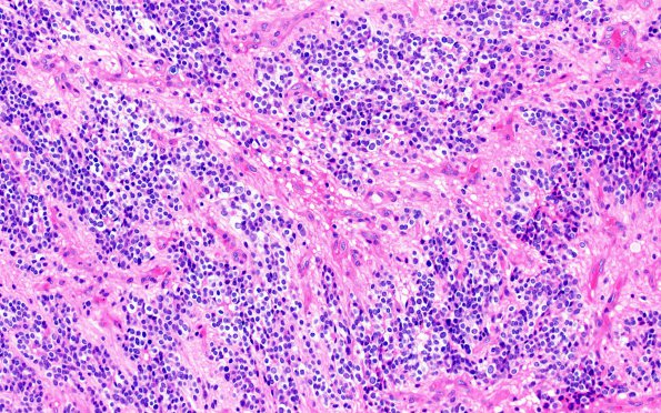 7A3 Ependymoma, anaplastic, clear cell (Case 7) H&E 20X 3