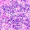 7A4 Ependymoma, anaplastic, clear cell (Case 7) H&E 60X