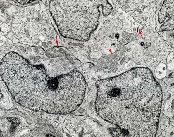 7B Ependymoma, anaplastic, clear cell (Case 7) EM copy - Copy