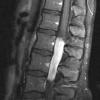 10A1 Ependymoma, myxopapillary (Case 10) T1 W - Copy - Copy