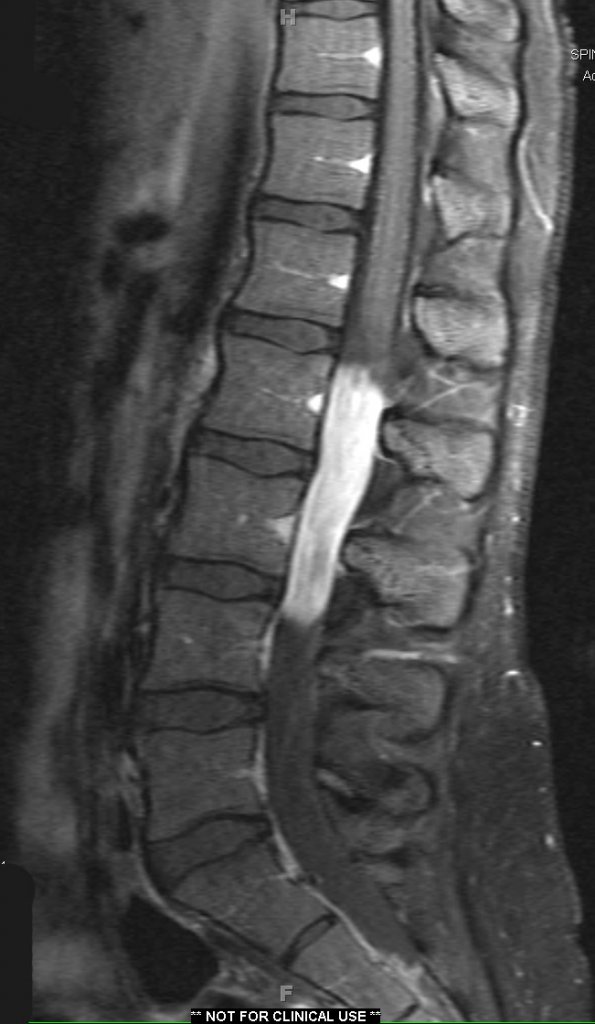 10A1 Ependymoma, myxopapillary (Case 10) T1 W - Copy - Copy