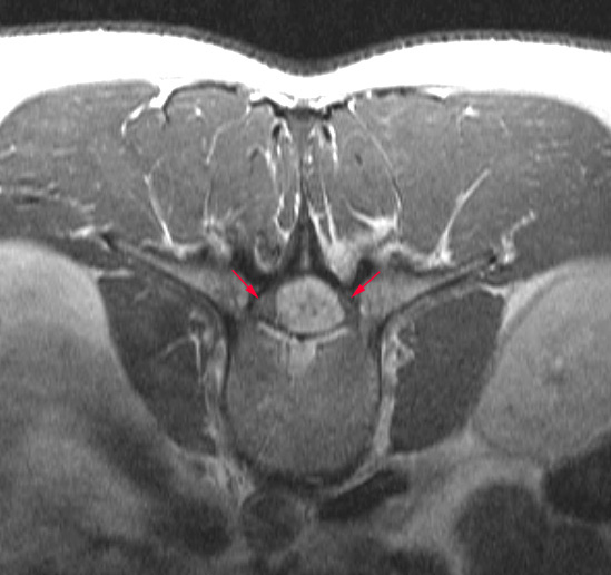 10A2 Ependymoma, myxopapillary (Case 10) T1 W2 - Copy - Copy copy