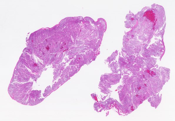 10B1 Ependymoma, myxopapillary (Case 10) H&E 9