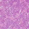 10B2 Ependymoma, myxopapillary (Case 10) H&E 10