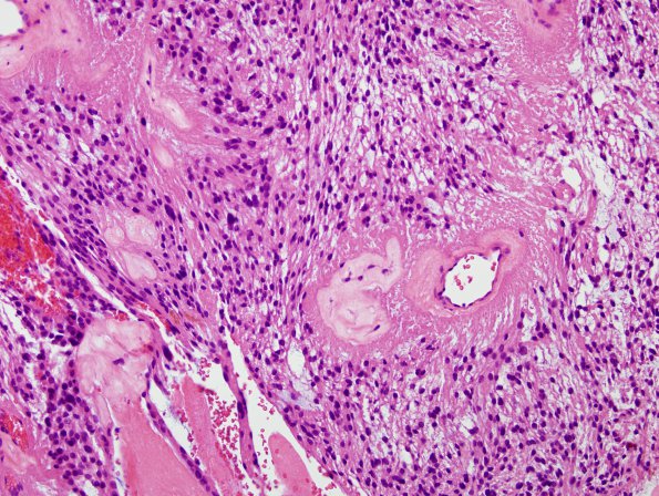 10B3 Ependymoma, myxopapillary (Case 10) H&E 11