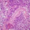 10B4 Ependymoma, myxopapillary (Case 10) H&E 2