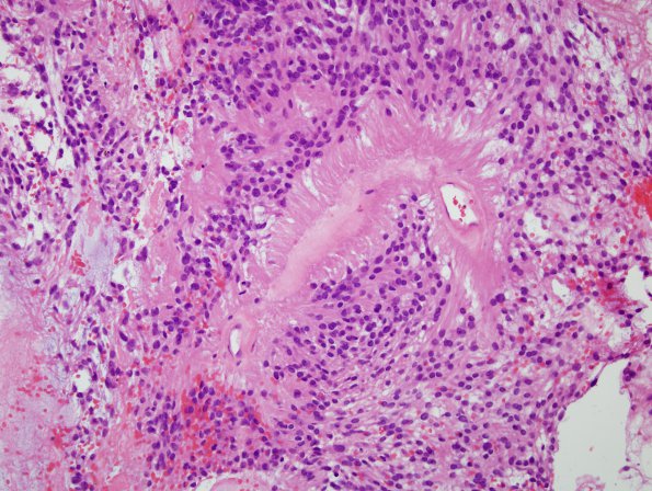 10B4 Ependymoma, myxopapillary (Case 10) H&E 2