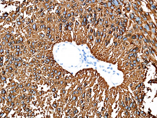 10C2 Ependymoma, myxopapillary (Case 10) GFAP 3