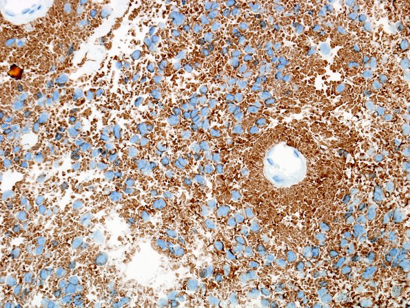 10C3 Ependymoma, myxopapillary (Case 10) GFAP 4