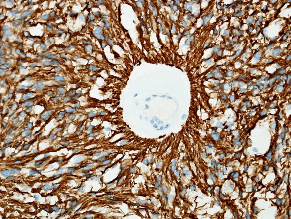 10C4 Ependymoma, myxopapillary (Case 10) GFAP 6