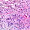 11A1 Ependymoma, myxopapillary (Case 11) H&E 5