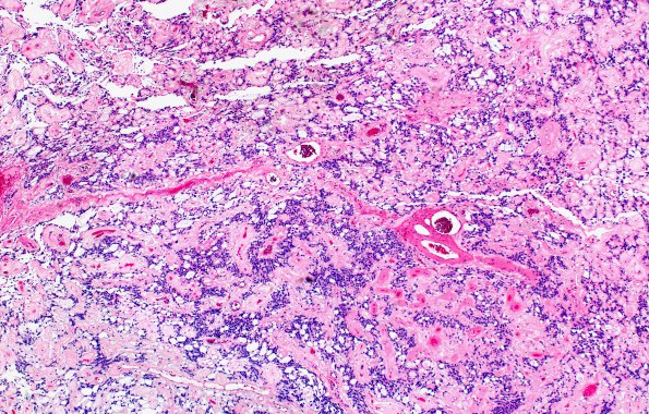 11A1 Ependymoma, myxopapillary (Case 11) H&E 5