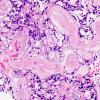 11A2 Ependymoma, myxopapillary (Case 11) H&E 2