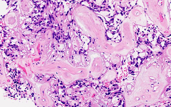 11A2 Ependymoma, myxopapillary (Case 11) H&E 2