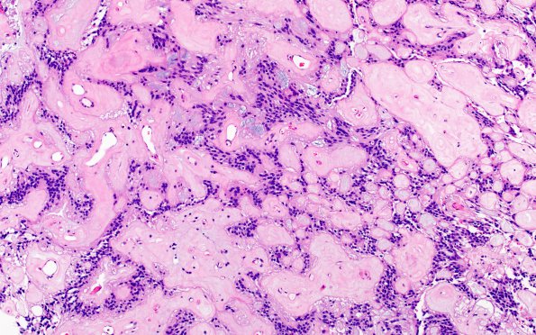 11A3 Ependymoma, myxopapillary (Case 11) H&E 3