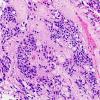 11A4 Ependymoma, myxopapillary (Case 11) H&E 7