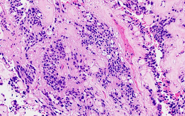 11A4 Ependymoma, myxopapillary (Case 11) H&E 7