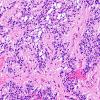 11A5 Ependymoma, myxopapillary (Case 11) H&E 8