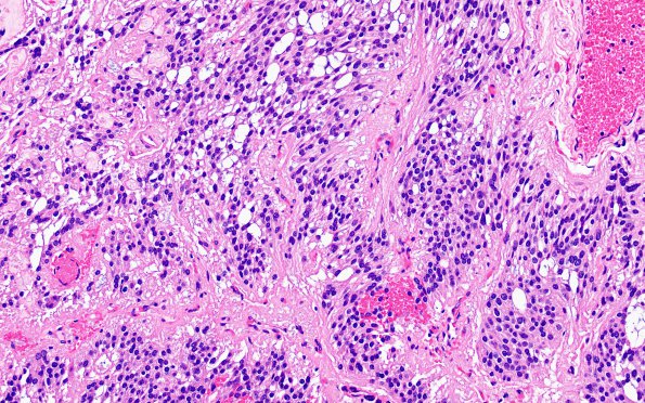 11A5 Ependymoma, myxopapillary (Case 11) H&E 8