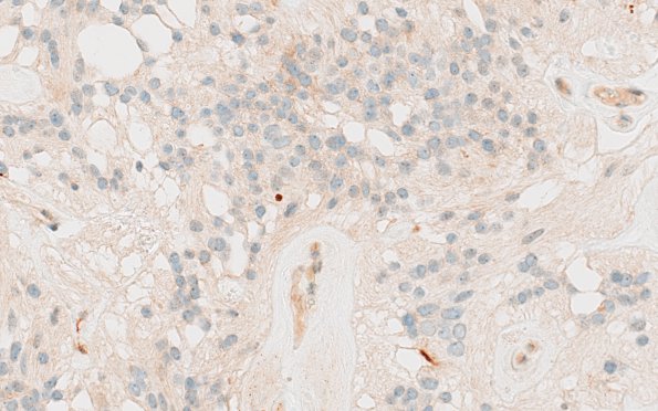 11C Ependymoma, myxopapillary (Case 11) EMA