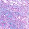 11D1 Ependymoma, myxopapillary (Case 11) Alcian Blue 3