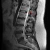 12A Ependymoma, myxopapillary (Case 12) T2 1 - Copy copy