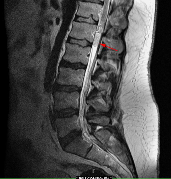 12A Ependymoma, myxopapillary (Case 12) T2 1 - Copy copy