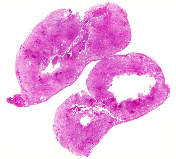 12B1 Ependymoma, myxopapillary (Case 12) H&E WM