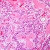 12B3 Ependymoma, myxopapillary (Case 12) H&E 4.jpg