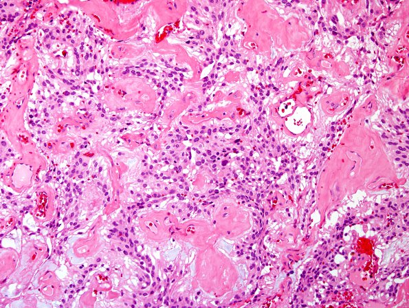 12B3 Ependymoma, myxopapillary (Case 12) H&E 4.jpg