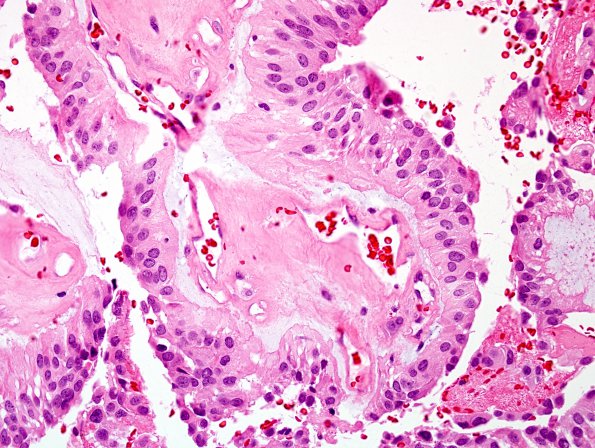 12B4 Ependymoma, myxopapillary (Case 12) H&E 6.jpg