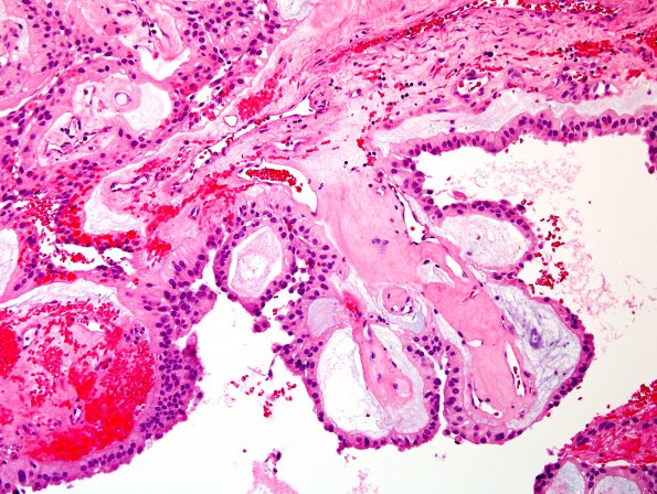 12B5 Ependymoma, myxopapillary (Case 12) H&E 11.jpg