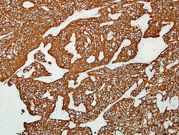 12C2 Ependymoma, myxopapillary (Case 12) GFAP 9.jpg