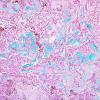 12D2 Ependymoma, myxopapillary (Case 12) Alcian Blue 6.jpg