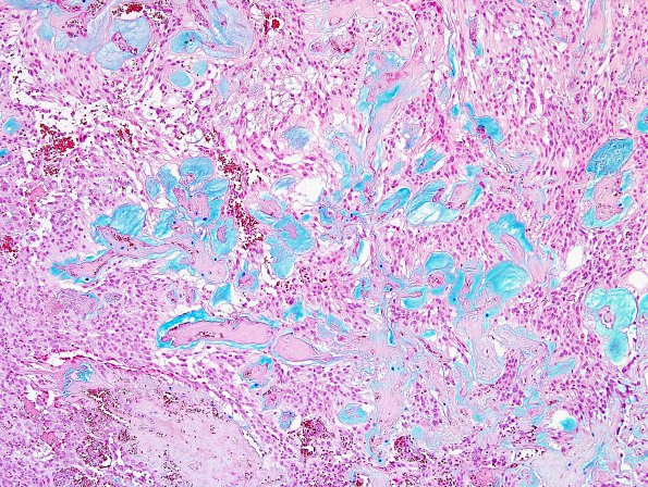 12D2 Ependymoma, myxopapillary (Case 12) Alcian Blue 6.jpg