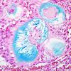 12D3 Ependymoma, myxopapillary (Case 12) Alcian Blue 1.jpg