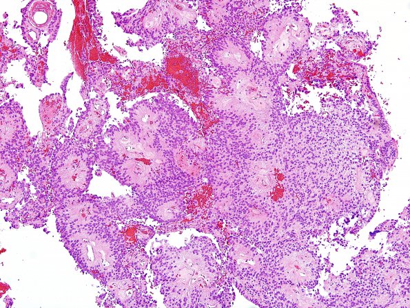 13A1 Ependymoma, myxopapillary (Case 13) H&E 3