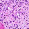 13A2 Ependymoma, myxopapillary (Case 13) H&E 5.jpg