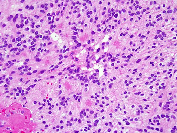 13A2 Ependymoma, myxopapillary (Case 13) H&E 5.jpg