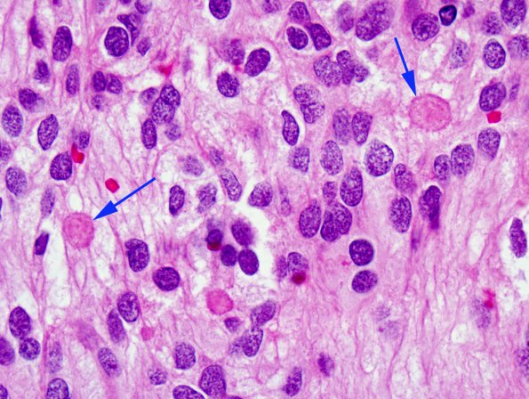 13A3 Ependymoma, myxopapillary (Case 13) H&E 4 copy.jpg