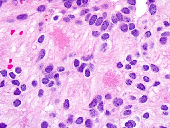 13A4 Ependymoma, myxopapillary (Case 13) H&E 6.jpg