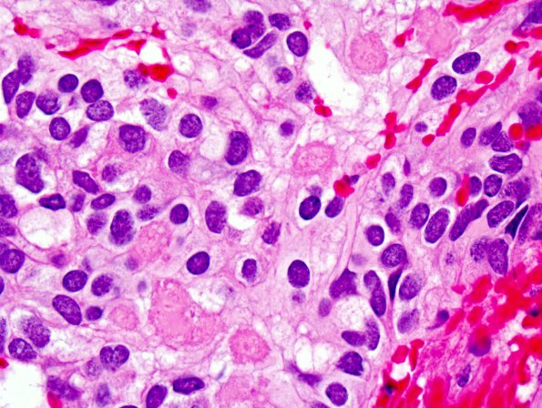 13A5 Ependymoma, myxopapillary (Case 13) H&E 3 (2).jpg