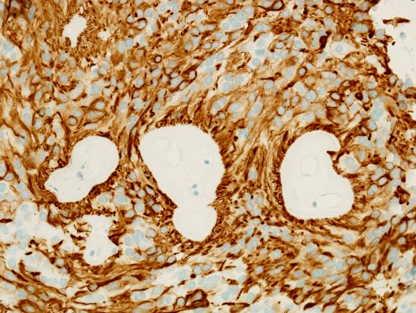 13B1 Ependymoma, myxopapillary (Case 13) GFAP 2